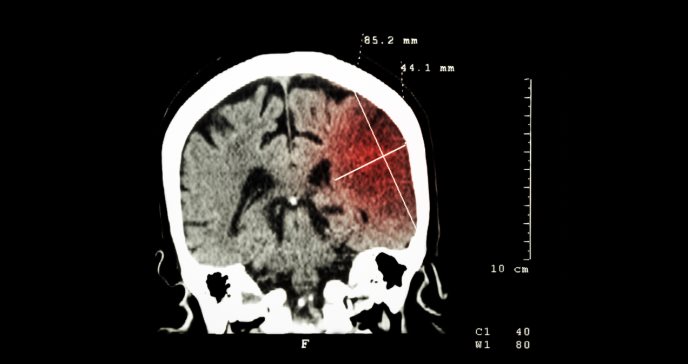 Mayor riesgo de mortalidad y discapacidad asociado a convulsiones tras accidente cerebrovascular (ACV)