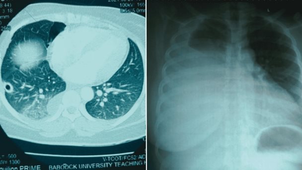 Tos y dolor torácico recurrente por más de 20 años termina en diagnóstico de endometriosis torácica (TES) Tos y dolor torácico recurrente por más de 20 años termina en diagnóstico de endometriosis torácica (TES)