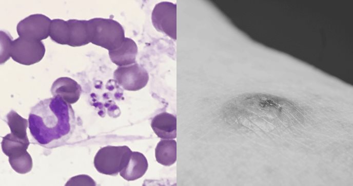 Psicosis en paciente por coinfección de VIH y leishmaniasis visceral agravada por síndrome hemofagocítico