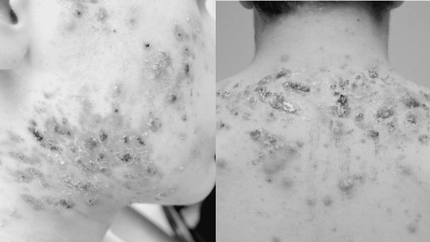 Paciente con úlceras es diagnosticado con acné fulminans tras infección de coronavirus y pulmonía Paciente con úlceras es diagnosticado con acné fulminans tras infección de coronavirus y pulmonía