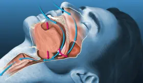 Relación de la apnea del sueño con el envejecimiento por acumulación de tejido graso en cuello y lengua