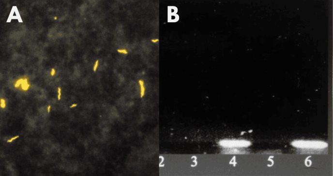 Detectan Helicobacter cinaedi en paciente con VIH tras presentar diarrea y fiebre intermitente