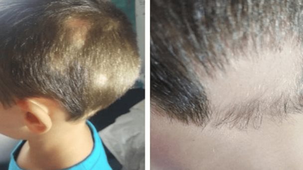 Desarrollan efectivo tópico con extractos de cacao, cebolla, limón y guaraná para tratar alopecia infantil Desarrollan efectivo tópico con extractos de cacao, cebolla, limón y guaraná para tratar alopecia infantil