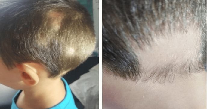 Desarrollan efectivo tópico con extractos de cacao, cebolla, limón y guaraná para tratar alopecia infantil