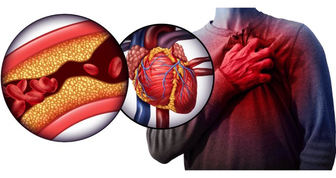 Depresión, ansiedad y estrés pueden acelerar factores de riesgo de infarto o derrame cerebral