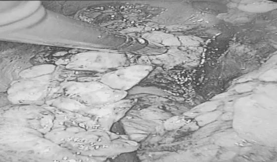 Detectan tumor productor de insulina en paciente diabético de 54 años