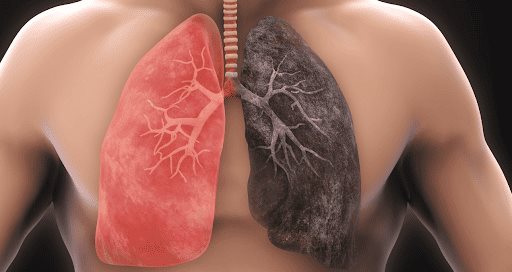 Diferencias y relación entre bronquitis crónica, Enfermedad Pulmonar Obstructiva Crónica y enfisema Diferencias y relación entre bronquitis crónica, Enfermedad Pulmonar Obstructiva Crónica y enfisema