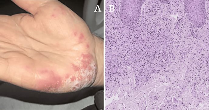 Síndrome Histiocitoide de Sweet asociado a Enfermedad de Crohn en paciente con diabetes