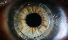 Soluci&oacute;n al queratocono mediante el implante de anillos intracorneales o intraestromales: &iquest;C&oacute;mo funciona?