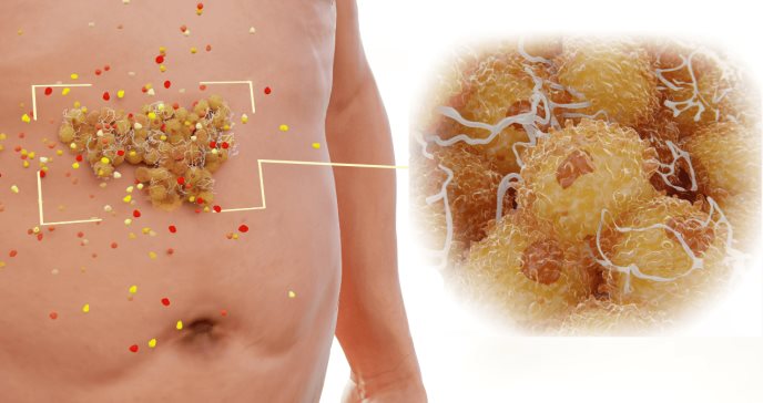 Grasa abdominal provoca cambios cerebrales y es un factor clave en el riesgo de padecer alzhéimer