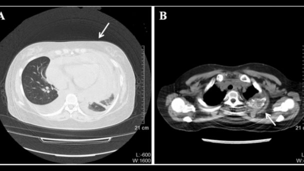 Neoplasia endocrina múltiple tipo 1 causa carcinoides ováricos metastásicos en paciente de 30 años Neoplasia endocrina múltiple tipo 1 causa carcinoides ováricos metastásicos en paciente de 30 años