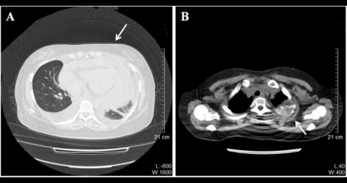 Neoplasia endocrina múltiple tipo 1 causa carcinoides ováricos metastásicos en paciente de 30 años