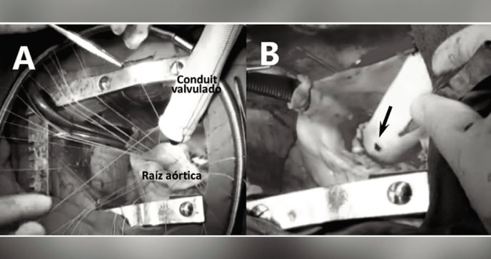 Síndrome de Marfan y la intervención quirúrgica cardiovascular en diámetros aórticos superiores a 40 mm