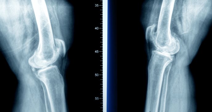 Dieta y ejercicio mejoran índice de osteoartritis en pacientes con obesidad, según estudio