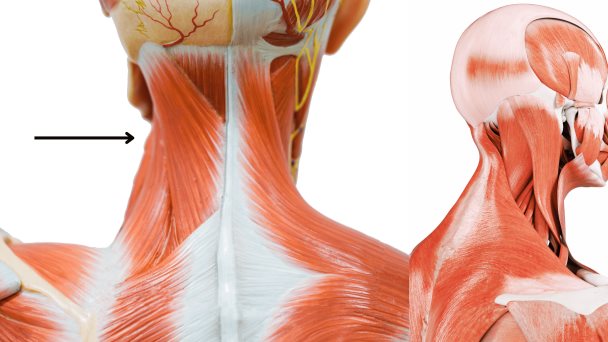 Descubren relación directa entre dolores de cabeza primarios e inflamación del cuello