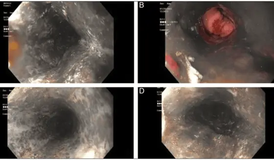 Descubren raro es&oacute;fago negro o necrosis esof&aacute;gica aguda en paciente con insuficiencia respiratoria