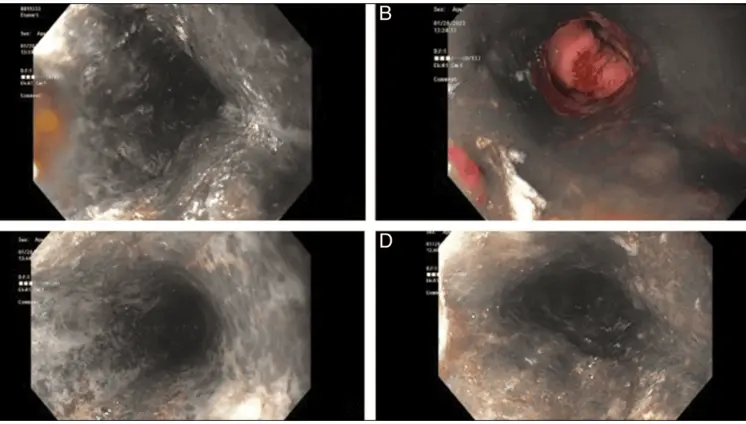 Descubren raro es&oacute;fago negro o necrosis esof&aacute;gica aguda en paciente con insuficiencia respiratoria