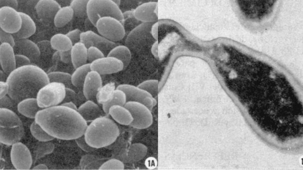 Síndrome de autofermentación intestinal: paciente se presenta ebrio en urgencias sin haber bebido Síndrome de autofermentación intestinal: paciente se presenta ebrio en urgencias sin haber bebido