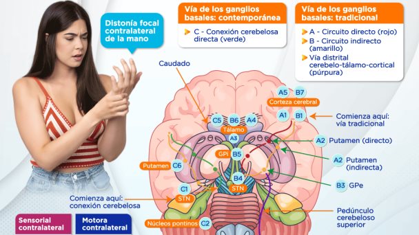 Cavernoma putaminal | Infografía