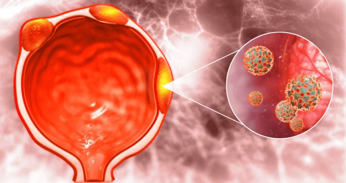 Investigadores revelan que la obesidad aumenta el riesgo de padecer cáncer de próstata