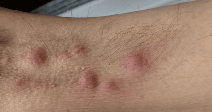 Hidradenitis Supurativa sigue afectando más a las mujeres, según estudio
