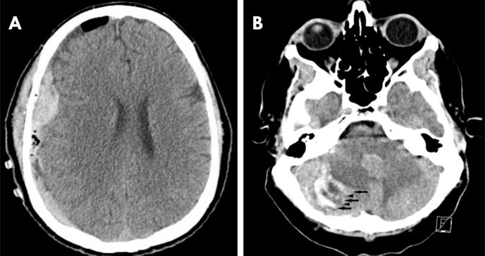 Paciente con hematoma subdural y hemorragia cerebelosa con signo de la cebra meses después de una caída