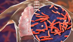 6 claves para diferenciar la Infección de tuberculosis latente y enfermedad de tuberculosis