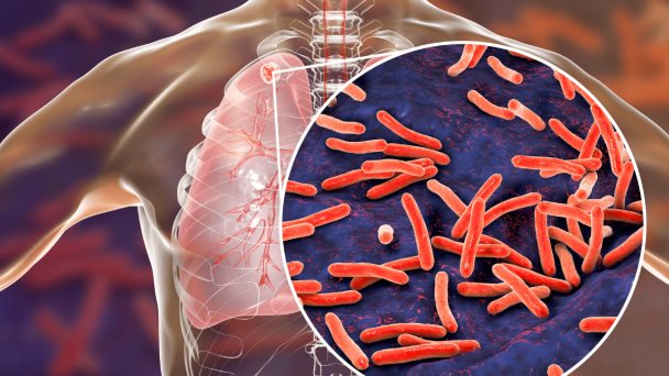 6 claves para diferenciar la Infección de tuberculosis latente y enfermedad de tuberculosis 6 claves para diferenciar la Infección de tuberculosis latente y enfermedad de tuberculosis