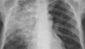 ´Síndrome de pulmón blanco´: ¿de qué se trata el brote de enfermedades respiratorias que azota a China?