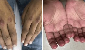 Paciente presenta rara combinación de policondritis recidivante y dermatomiositis clínicamente amiopática