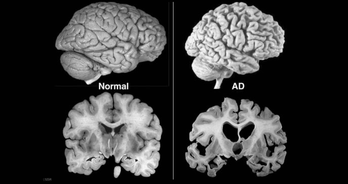 Fumar encogería el cerebro según estudio y sería clave en el deterioro cognitivo o desarrollo de alzhéimer