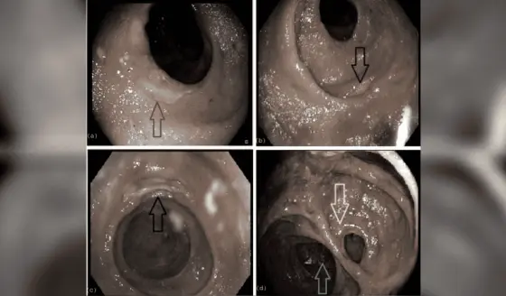 Complicaciones farmacológicas: Hombre de 68 años desarrolla Colitis inducida por Micofenolato