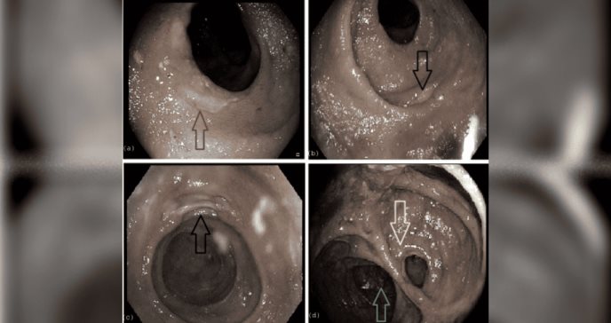 Complicaciones farmacológicas: Hombre de 68 años desarrolla Colitis inducida por Micofenolato