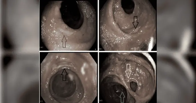 Complicaciones farmacológicas: Hombre de 68 años desarrolla Colitis inducida por Micofenolato