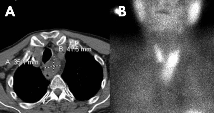 Adenoma Paratiroideo Ectópico en paciente con hipercalcemia deriva en hipofonía tras operación