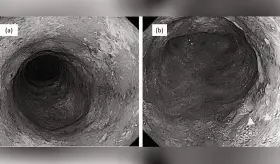 Manejo exitoso de colitis ulcerosa con vedolizumab en presencia de neumonía e infecciones oportunistas