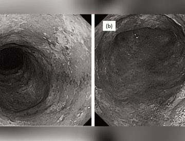 Manejo exitoso de colitis ulcerosa con vedolizumab en presencia de neumonía e infecciones oportunistas