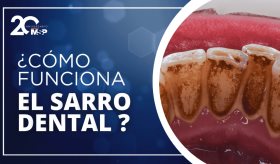 ¿Cómo funciona el sarro dental?