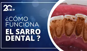 ¿Cómo funciona el sarro dental?