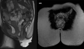 ¿Mucho tiempo sentado en el inodoro con el celular? Cuidado porque podría desencadenar un prolapso rectal