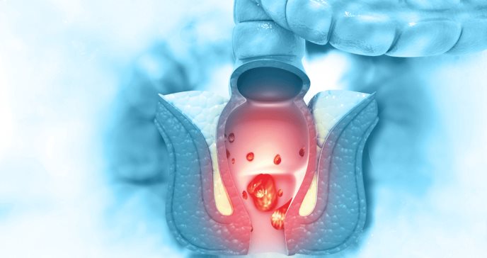 Identificar el cáncer de ano: picazón, dolor y abultamientos en la zona anal como signos clave