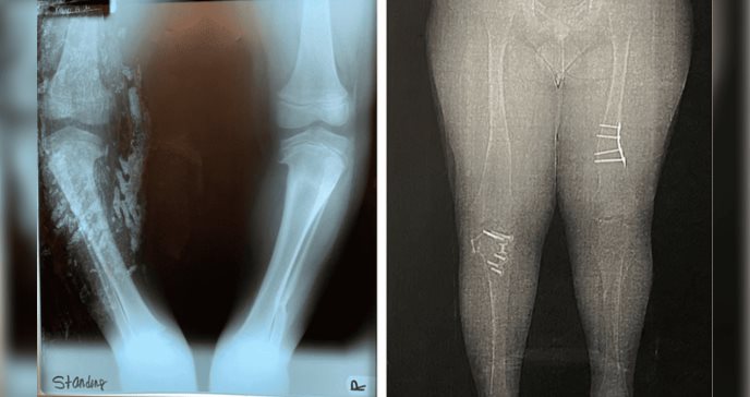 Polidactilia, obesidad y retinosis pigmentaria: Criterios diagnósticos de Síndrome Bardet-Biedl