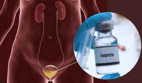 Cistitis hemorrágica, daño irreversible a vejiga y otros riesgos del uso prolongado de Ketamina