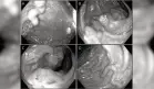 Mujer con hígado graso presenta várices en el colon con masa sigmoidea y arroja positivo a adenocarcinoma