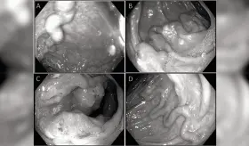 Mujer con hígado graso presenta várices en el colon con masa sigmoidea y arroja positivo a adenocarcinoma
