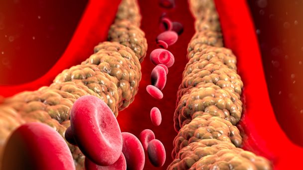 Inclisirán: la terapia de ARN que reduce significativamente colesterol LDL con solo 2 inyecciones al año