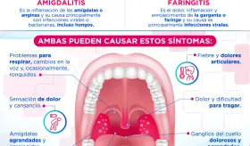 Amigdalitis y faringitis ¿Cuál es la diferencia?  | Infografía