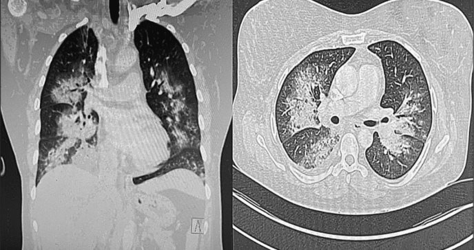 Mujer contrae infección por Legionella en casa de alquiler y es el primer caso descrito de su tipo