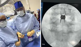 Realizan con éxito el primer implante Vertiflex para estenosis espinal en Hospital Damas