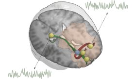 Frenar deterioro de sustancia blanca con estimulación cerebral reduciría recaídas por consumo de alcohol